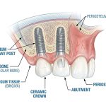 Front Dental Implants: What They Are, How They Work, and What the Process Really Looks Like
