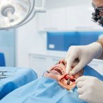 The Complete Process of Bone Grafting for Dental Implants