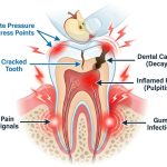 Why Does My Tooth Hurt When I Bite Down?