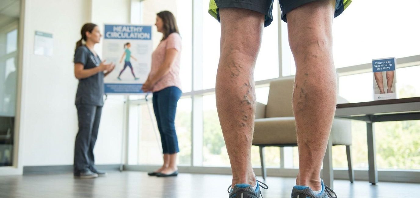 How to Prevent Varicose Veins: Simple Daily Habits for Healthier Legs